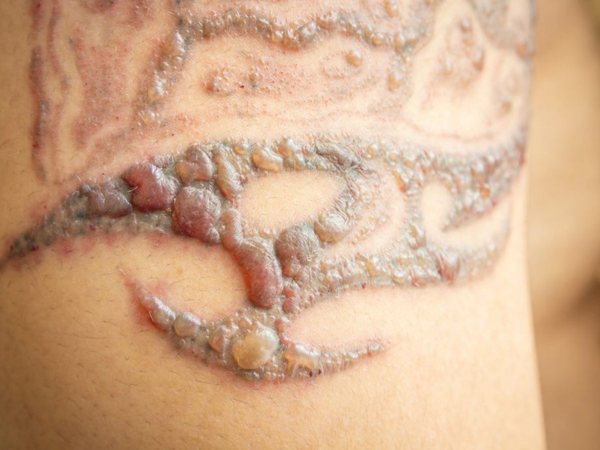 Does laser tattoo removal blister