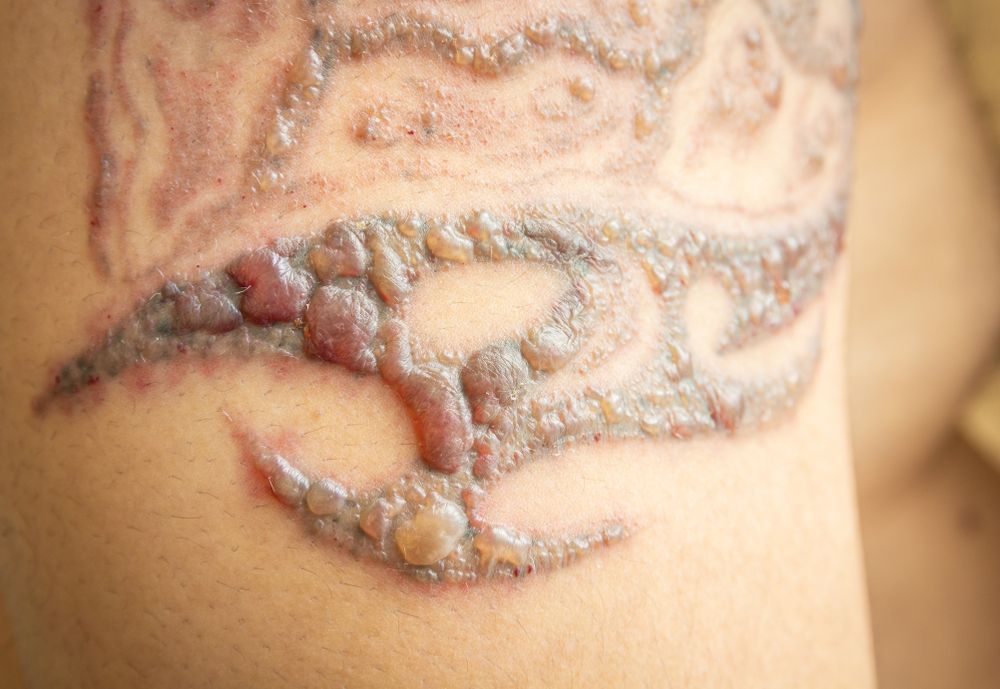 Tattoo removal bumps