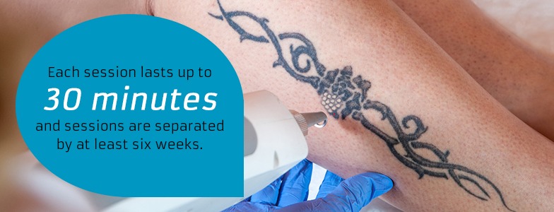 Laser tattoo removal sessions typically last up to 30 minutes