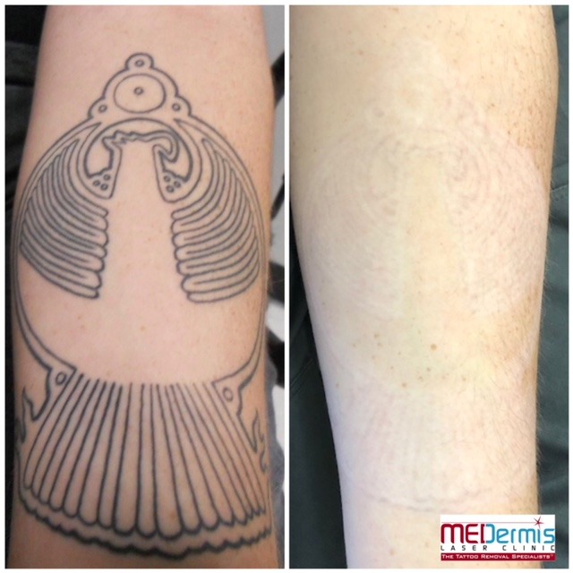 Arm-Laser-Tattoo-Entfernung in 12 Behandlungen