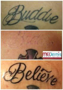 medermis laser tattoo removal for cover up in 5 treatments