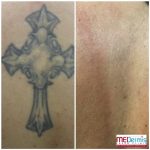 medermis laser tattoo removal in 5 treatments