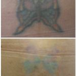 multiple color laser tattoo removal in 6 treatments