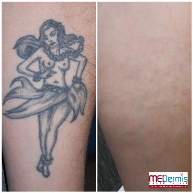 Arm-Laser-Tattoo-Entfernung in 9 Behandlungen