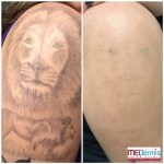 Shoulder/arm laser tattoo removal in 2 treatments