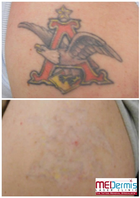 Tattooentfernung mit Laser mit schwarzer roter gelber Tinte in 10 Behandlungen