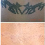 medermis laser tattoo removal in 14 treatments
