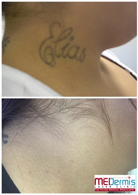 Neck & Face Laser Tattoo Removal Before & After Results | MEDermis