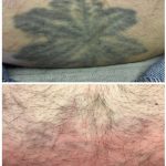 medermis laser tattoo removal in 3 treatments