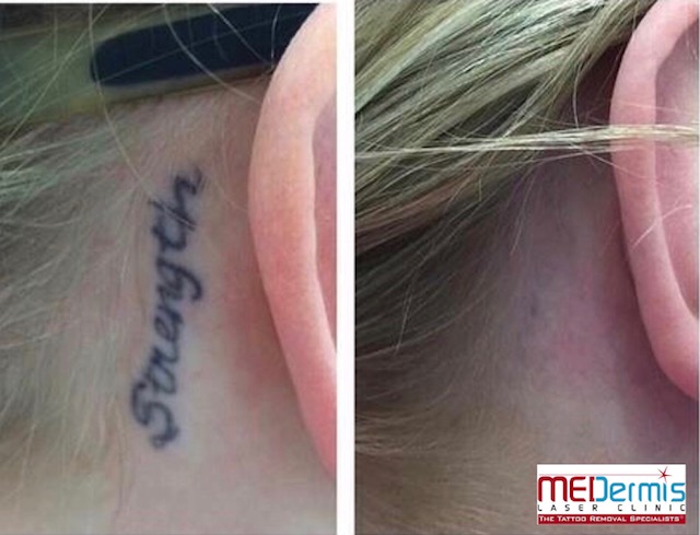 medermis laser tattoo removal in 4 treatments best in austin