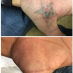 red and green star tattoo removal palm of hand