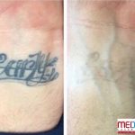 carly name tattoo removal inner wrist
