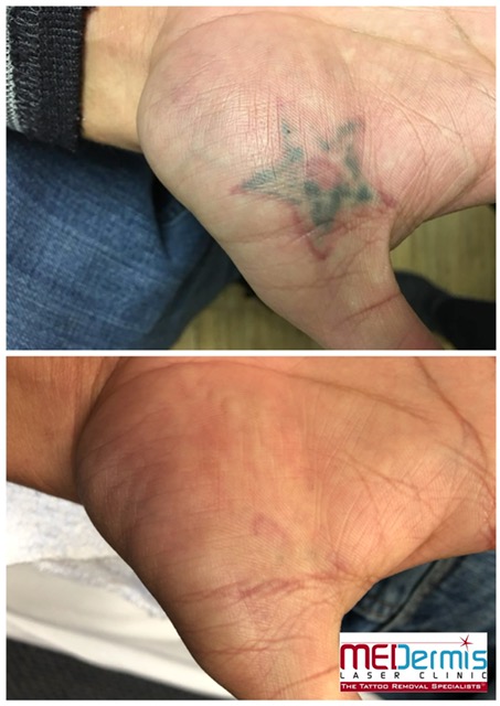red and green star tattoo removal palm of hand