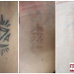 wrist laser tattoo removal in 4 treatments best in san antonio texas