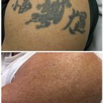black arm tattoo laser tattoo removal in 5 treatments