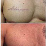 medermis laser tattoo removal in 6 treatments