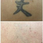 medermis laser tattoo removal in 7 treatments