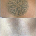 medermis laser tattoo removal in 8 treatments