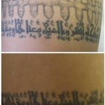 section of tattoo laser tattoo removal in 9 treatments