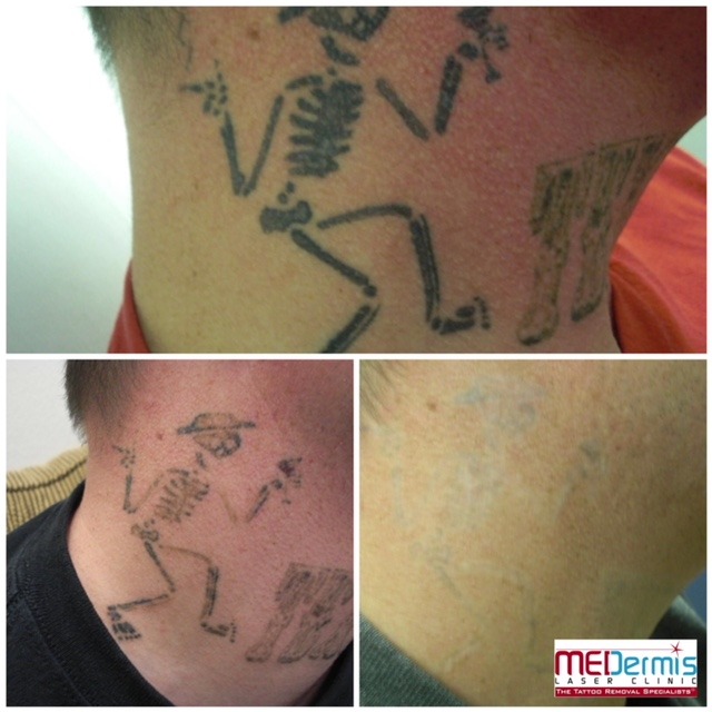 black ink on neck laser tattoo removal in 6 treatments