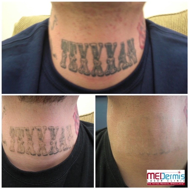 medermis laser tattoo removal in 6 treatments