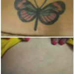 Hip green and black ink tattoo laser tattoo removal in 12 treatments