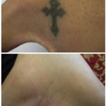 Hand laser tattoo removal in 4 treatments