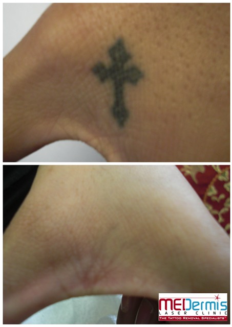 Hand laser tattoo removal in 4 treatments