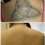 black ink tattoo on back laser tattoo removal in 10 treatments