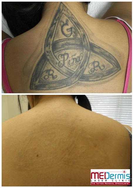 black ink tattoo on back laser tattoo removal in 10 treatments