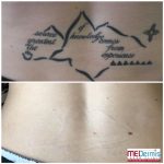pico laser tattoo removal in 10 treatments