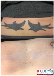 results of laser tattoo removal of lower back black tattoo of two birds