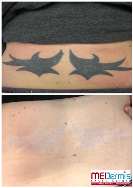 spectra laser tattoo removal in 11 treatments