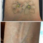 medermis laser tattoo removal in 4 treatments