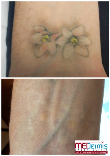 medermis Laser-Tattooentfernung in 4 Behandlungen