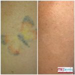 most advanced laser tattoo removal in 4 treatments