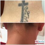 most experience laser tattoo removal in 5 treatments