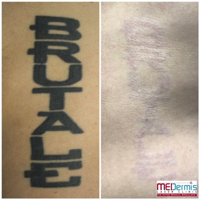Before & After 12 laser treatments at MEDermis Laser Clinic