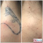 Before & After 3 laser treatments at MEDermis Laser Clinic