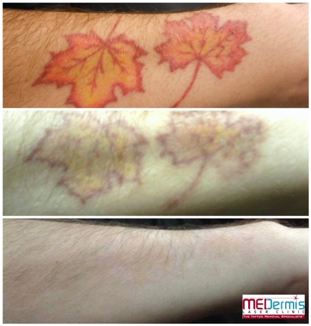 Before & After 6 laser treatments at MEDermis Laser Clinic