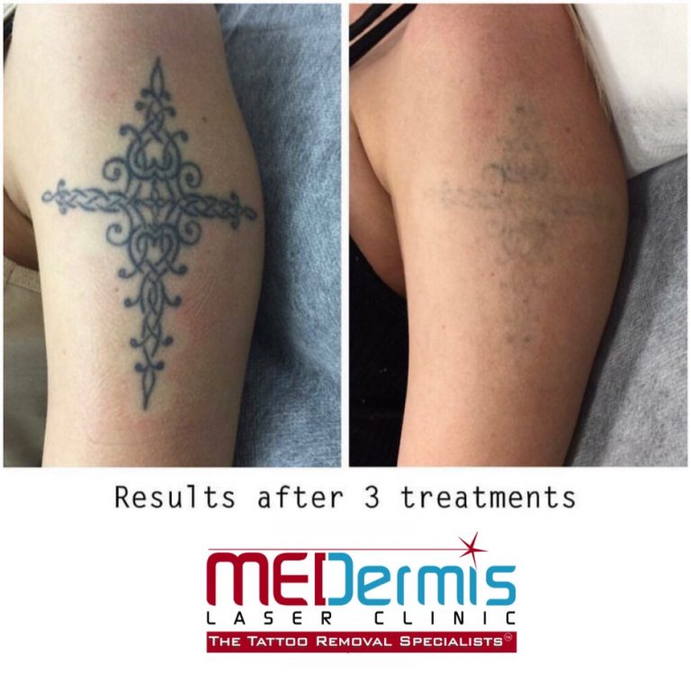 Photo Gallery Laser Tattoo Removal Before & After Results MEDermis