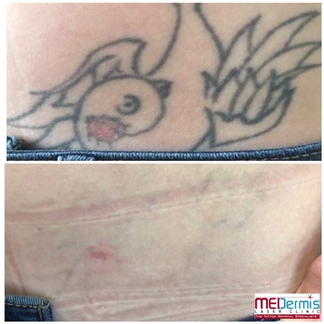 Before and After picture of 6 laser treaments