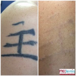 Before and After showing results of 8 laser treatments for a Chinese character on a man's shoulder