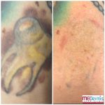 Before and After picture of 3 laser treaments