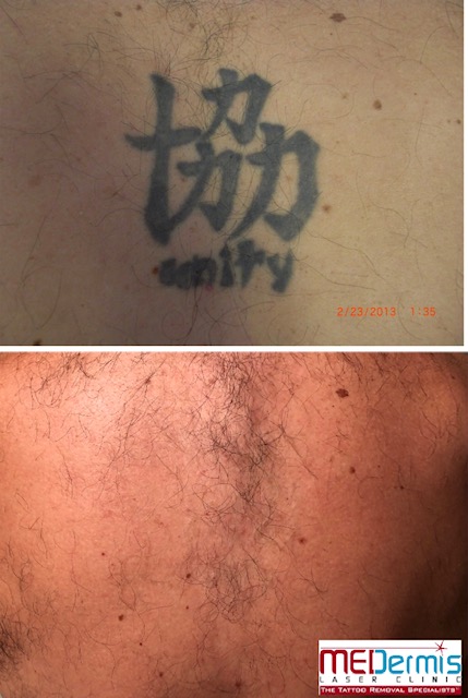 Before and After picture of 4 laser treaments