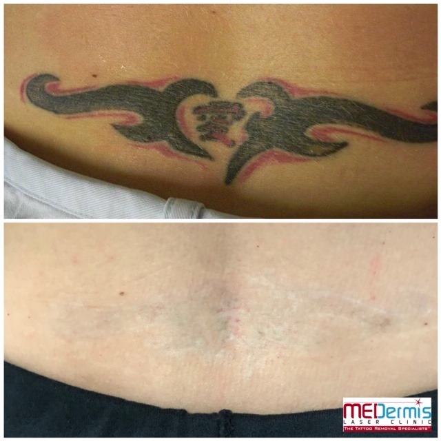 Before and After picture of 9 laser treaments