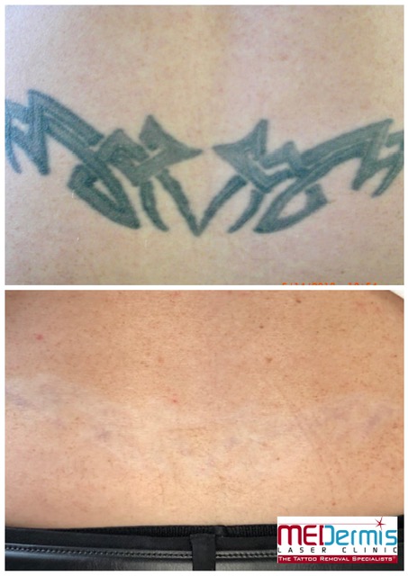 Before and After picture of 15 laser treaments