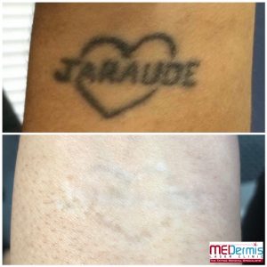 Laser removal of the name Jaraude showing results after e treatments