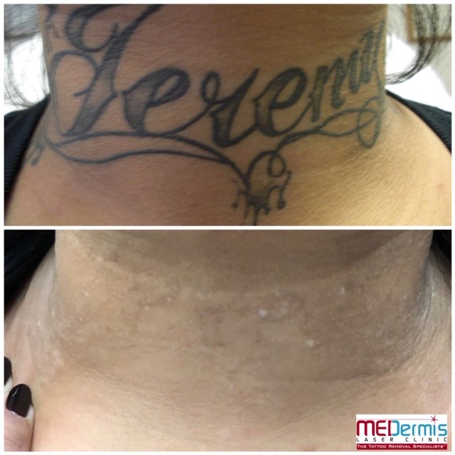 Before and After picture of 10 laser treaments