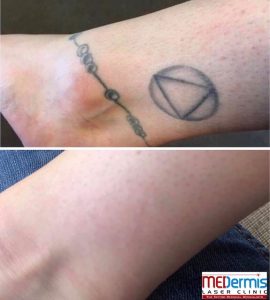 Before and after laser removal treatment of a tattooed geometric shape and anklet on a woman's ankle
